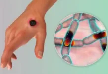 Lagos Confirms Six Cases Of Anthrax Disease First Case of Anthrax Confirmed in Nigeria