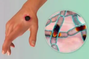 Lagos Confirms Six Cases Of Anthrax Disease