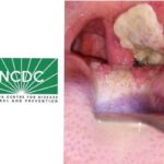 NCDC and a sample diphtheria disease