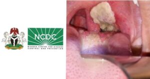 NCDC urges states to fight diphtheria with vaccine education campaigns
