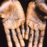 Mpox Infection