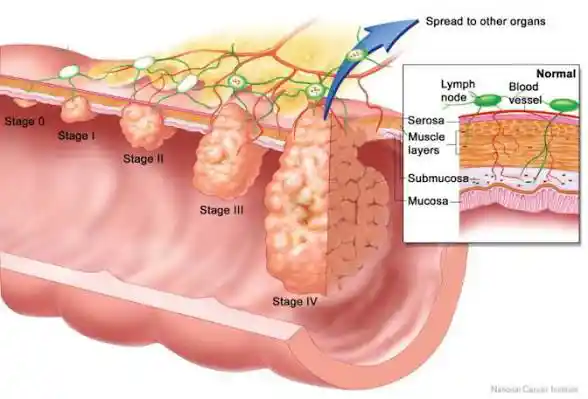 Stop Cancer Before It Starts: 10 Must-Know Tips